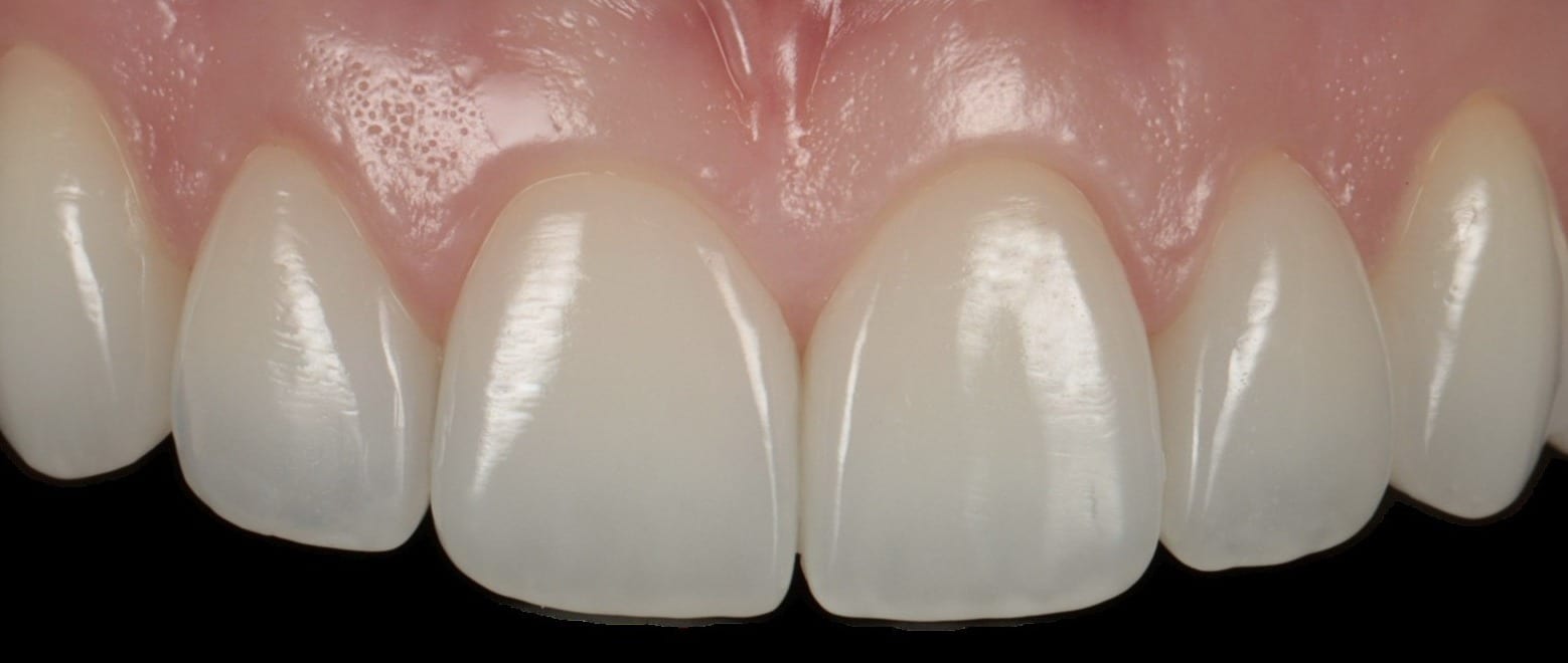 Composite bonding in Windsor by cosmetic dentist Dr. Albert Gajdos