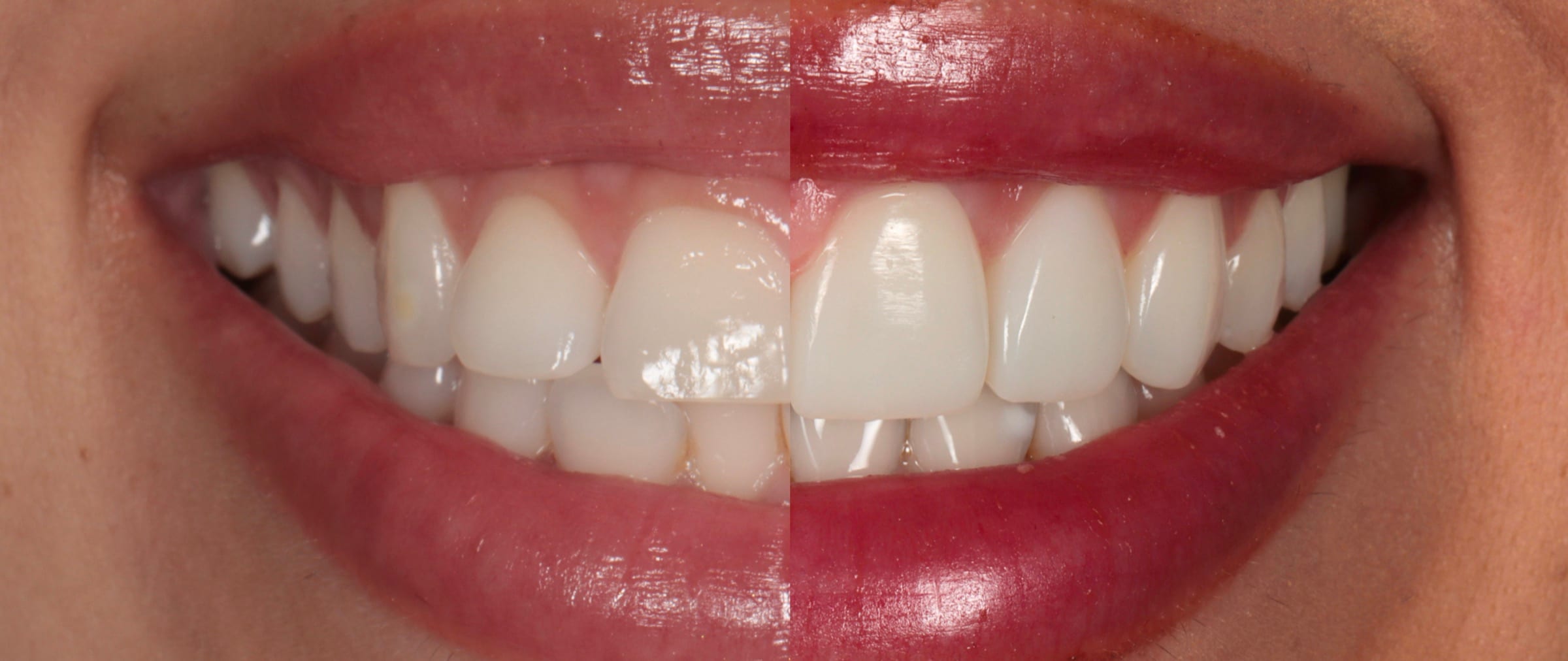 Gum shaping in Windsor by cosmetic dentist Dr. Albert Gajdos