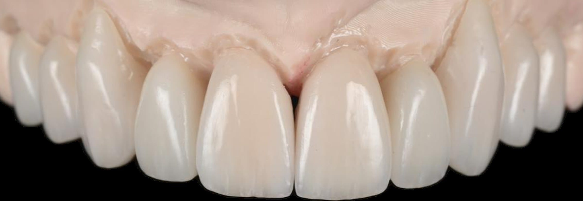 Porcelain veneers in Windsor by cosmetic dentist Dr. Albert Gajdos