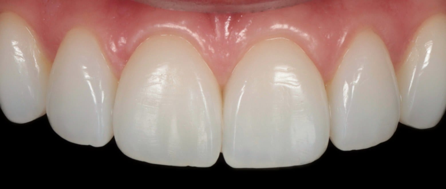 Professional teeth whitening in Windsor by Dr. Albert Gajdos