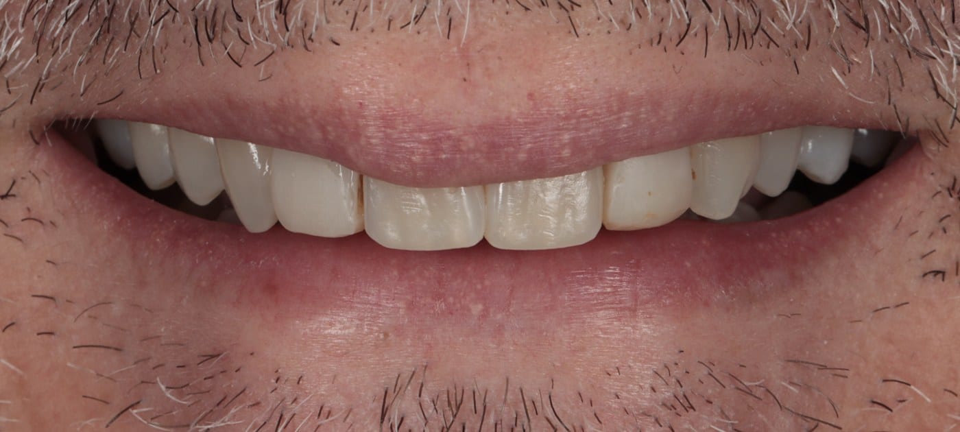 Before — natural teeth ready for treatment
