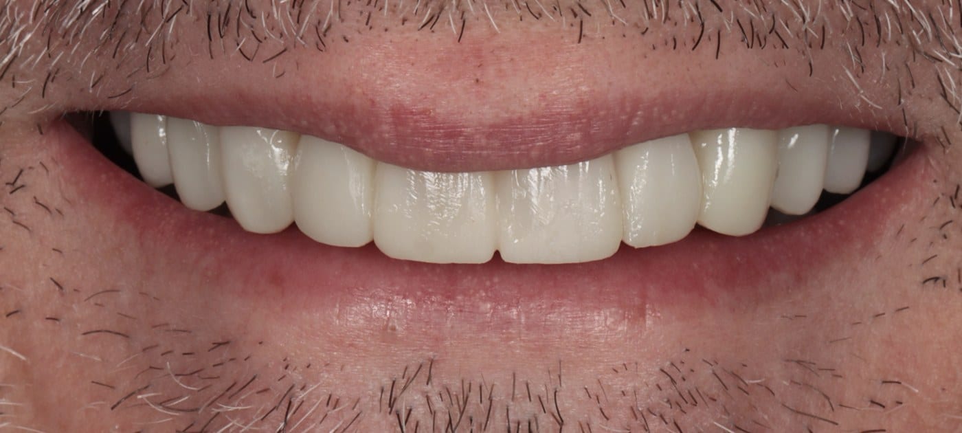 A trial smile lets you preview veneers before any tooth is prepared