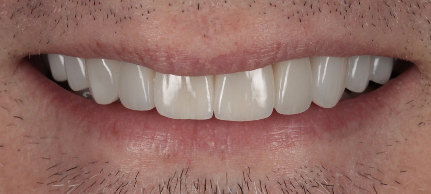 Natural porcelain veneers that protect the tooth underneath