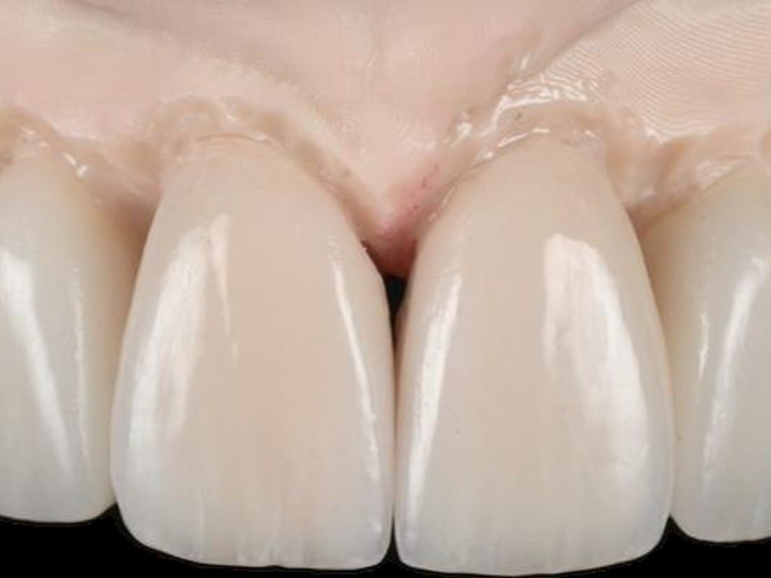 Final porcelain veneer next to natural tooth