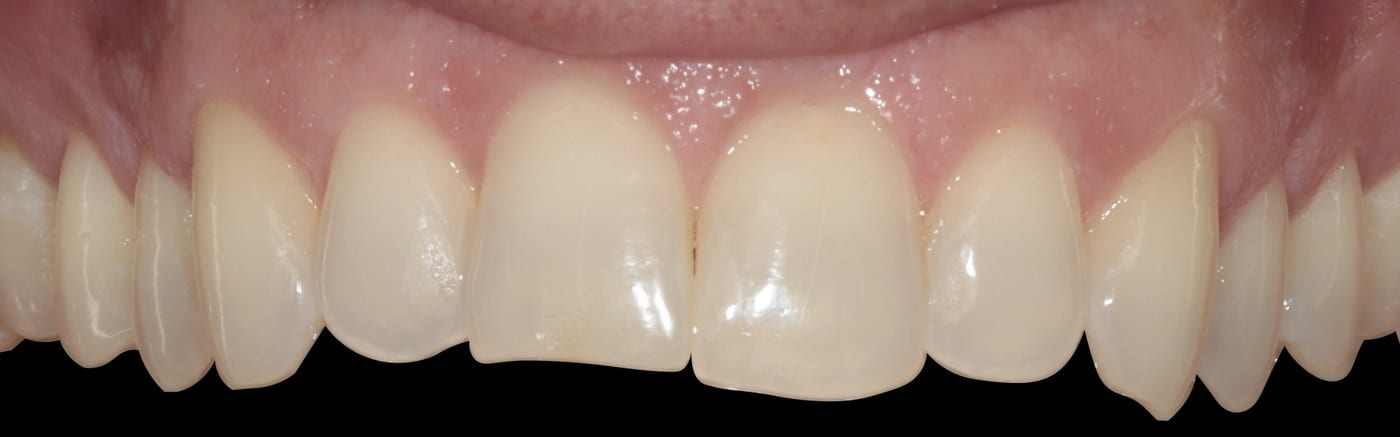 Before preparation — natural enamel intact